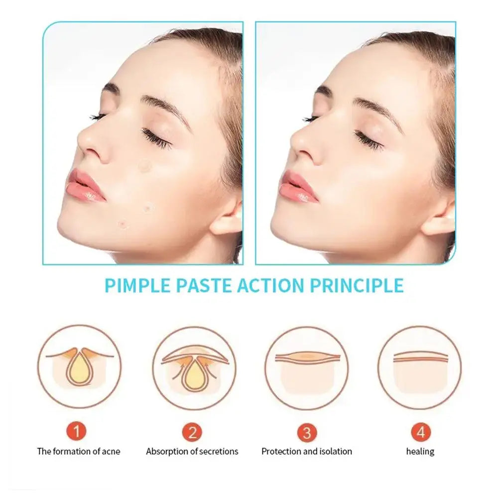 NEW 30PCS High-end Pimple Stickers Self Adhesive Disposable Round Pimple Acne Concealer Patch Makeup Cosmetics Women Skin Care